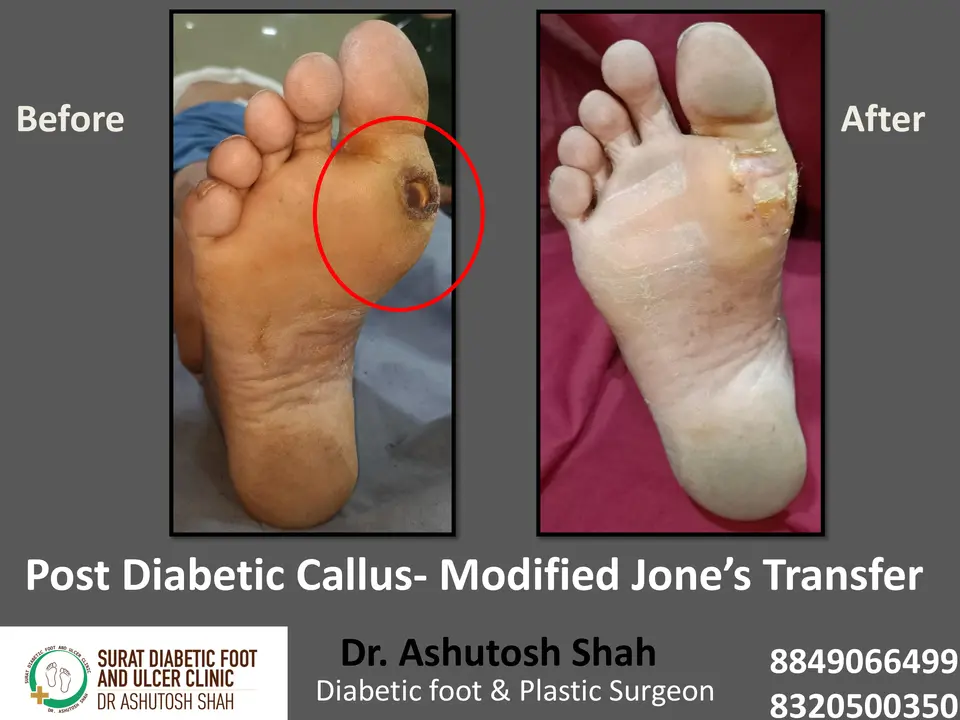 Diabetic Foot  PPT 3 checked by sir.pptx-32.webp